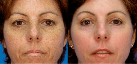Rejuvenecer en el lugar